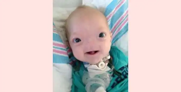 ‘Miracle Baby’ Born Without A Nose Dies At The Age Of Two Graphic Photos